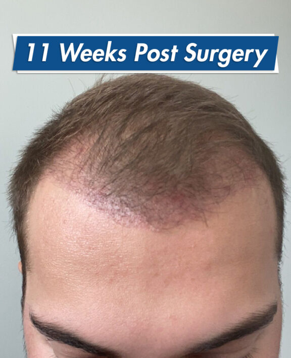 Redness After Hair Transplant How To Reduce Redness And How Long It Lasts