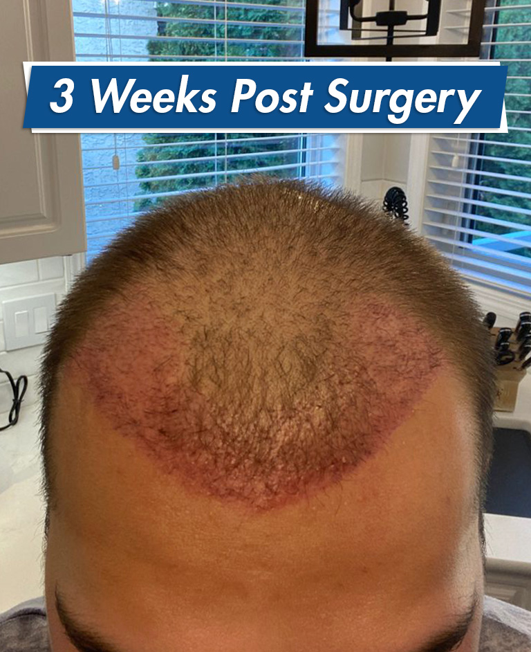 Hair Transplant Results After 3 Months  Hair Growth Images  Effects