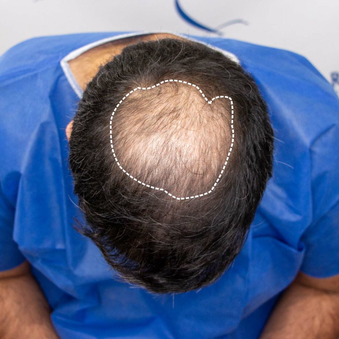 Crown Hair Transplant The Sharma Clinic