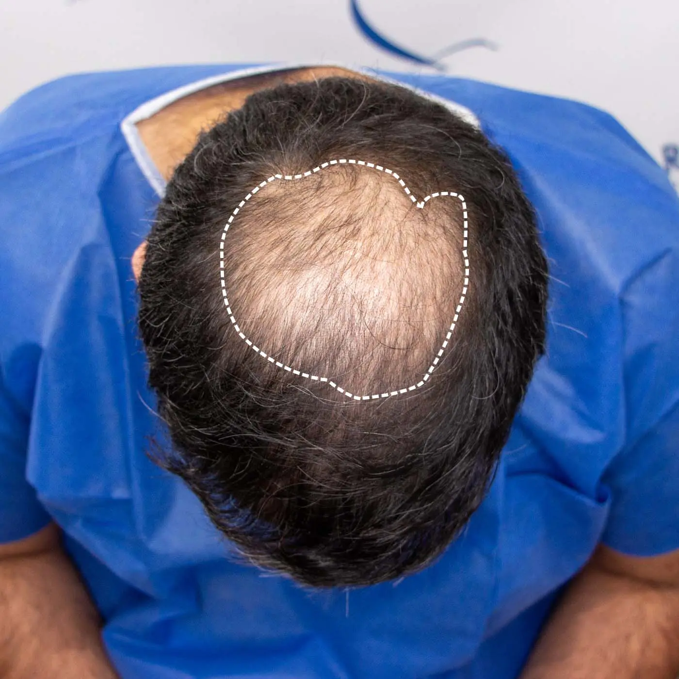 Crown Hair Transplants  Types Cost Timeline  Aventus Clinic