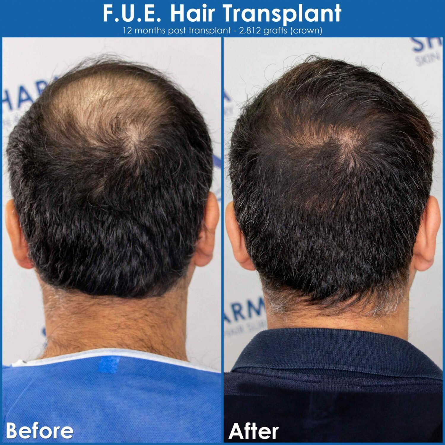 Crown Hair Transplant | The Sharma Clinic