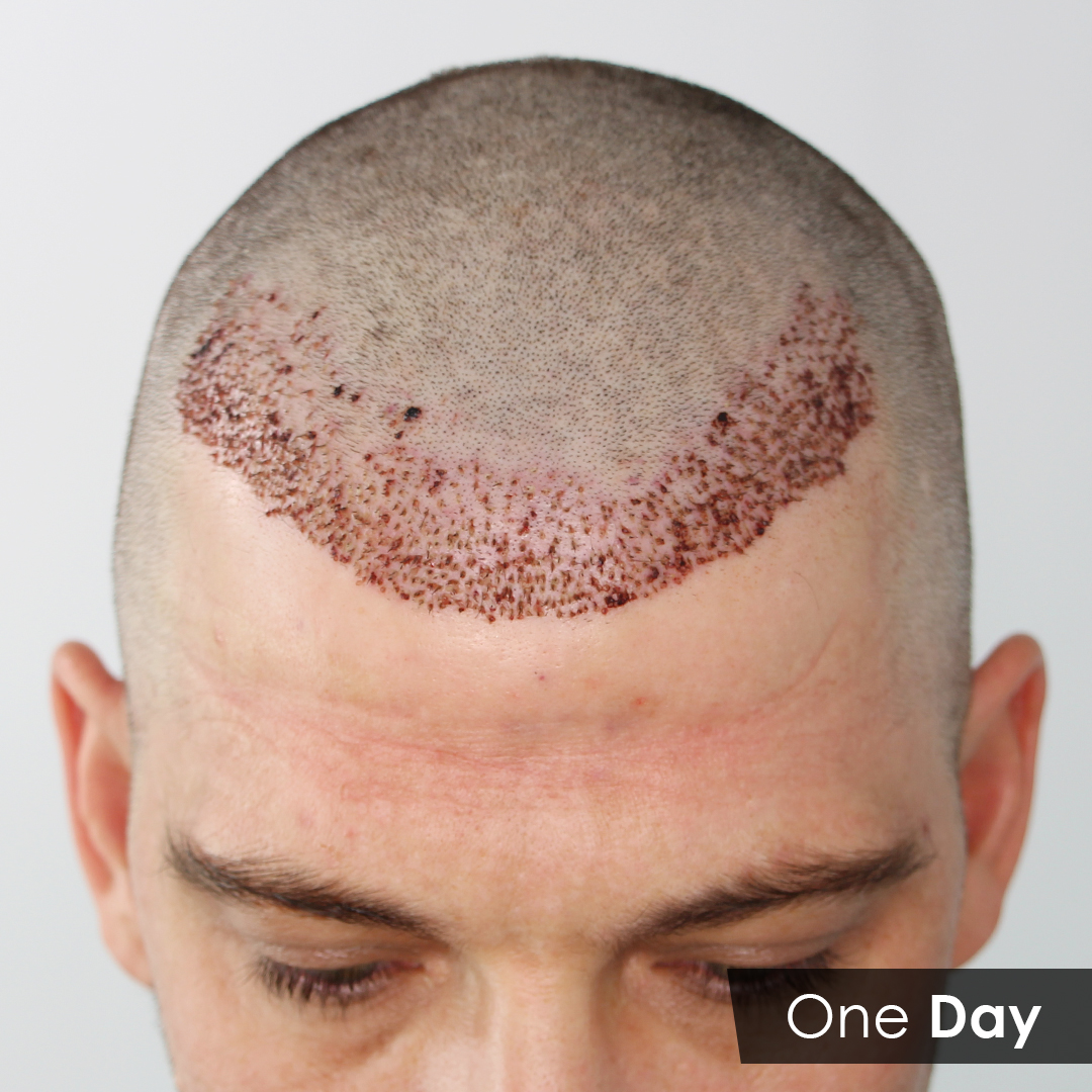 How Long Does A Hair Transplant Take To Recover  Asli Tarcan Clinic