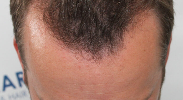 Hair line transplant Before