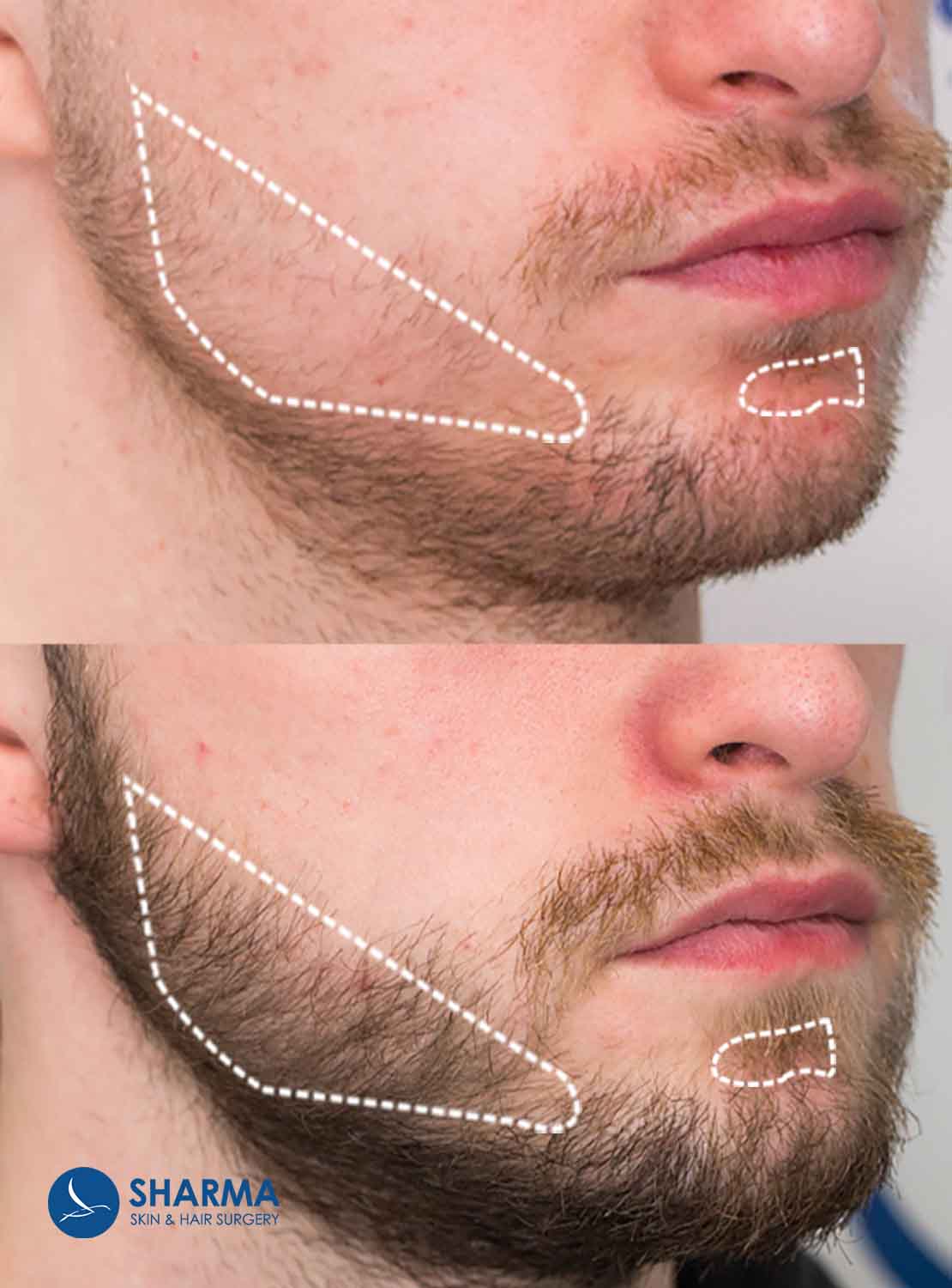 Beard Transplant in Edmonton