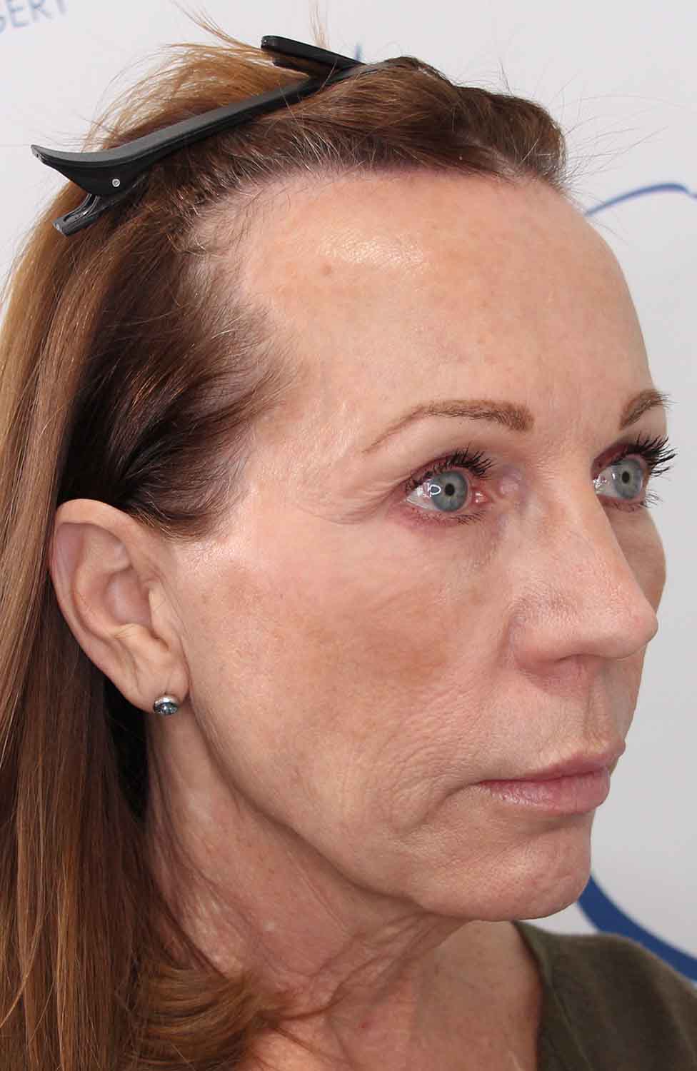 Donna FUT hair transplant