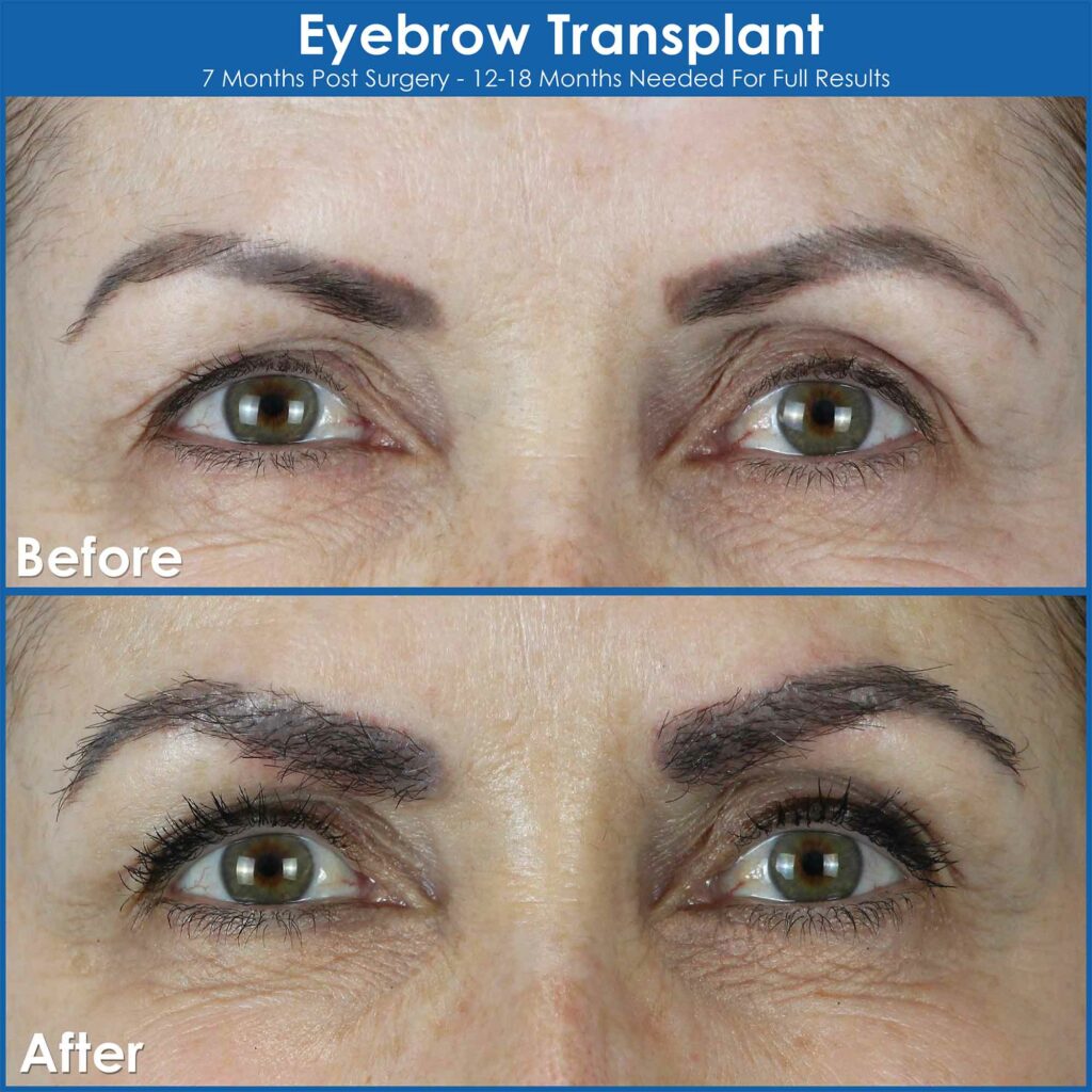 Eyebrow transplant before and after in Edmonton Alberta
