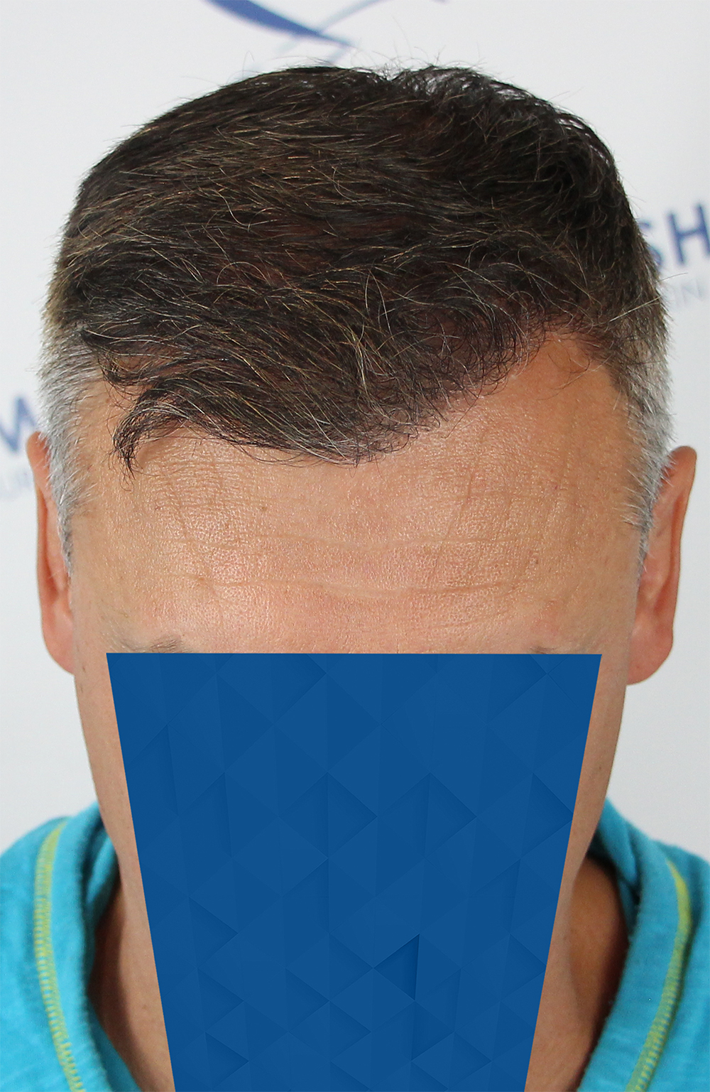 Danail D After Front Tilt 2500 grafts