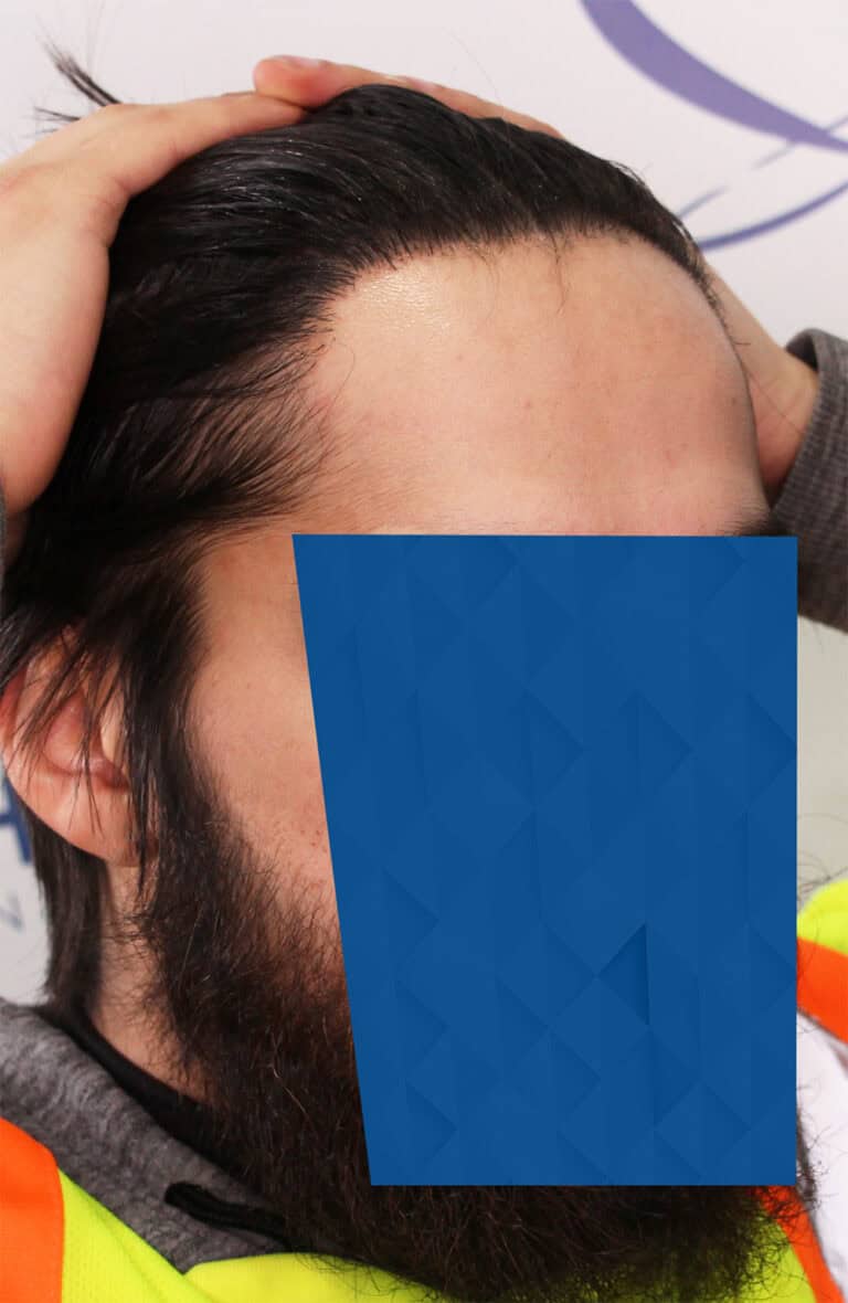 AFTER 2 FUE hairline hair transplant