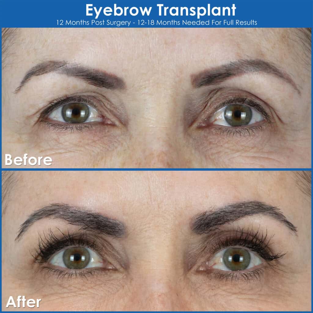 A before and after photo of an eyebrow transplant in Edmonton, Canada.